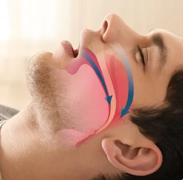 Cirugía para trastornos de ronquido