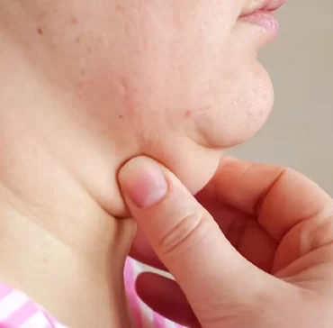 Liposucción de la papada