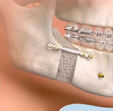 Cirugía Maxilofacial