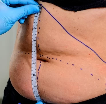 Cirugía Plástica Corporal